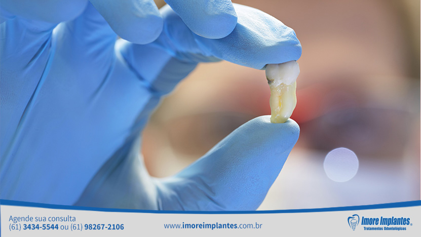 Reconhecemos que há recomendação de muitos dentistas para a extração do siso. Os sisos apresentam alguns problemas que os condenam na maioria das vezes.